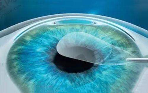 北京同仁眼科挂号代办,分享多渠道挂号技巧及卢炜、王红医生出诊预约信息