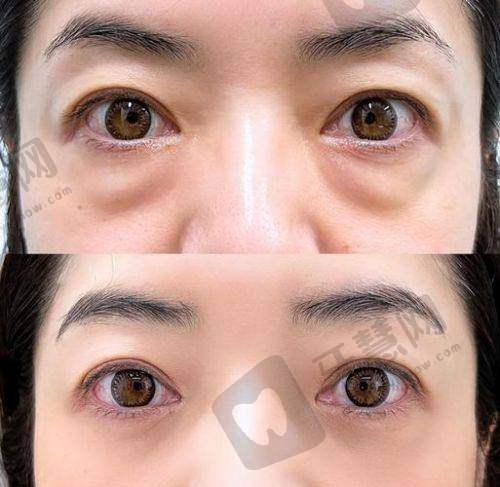 三、福州美贝尔医疗美容:高性价比祛眼袋选择