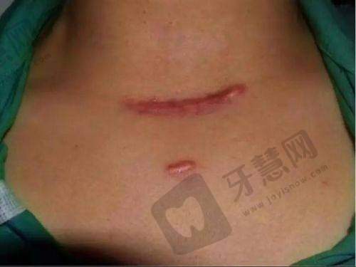 不同类型疤痕的治疗方案