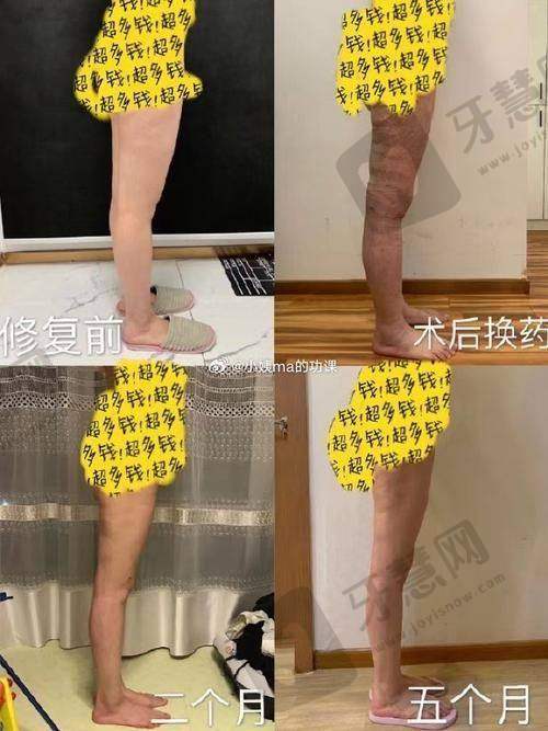 成都吸脂减肥哪里划算?西区医院价格亲民,邓东伟等专家团队资质有保障