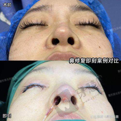 2024广州鼻修复医生排名前十新鲜出炉!附价格及技术特色,助你选对医生
