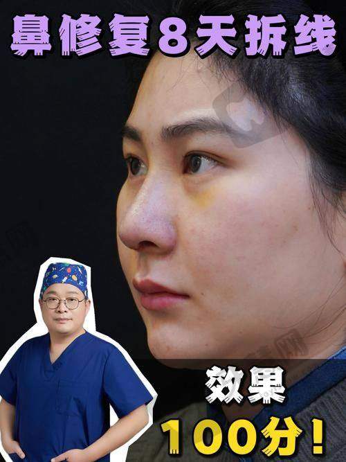 鼻修复前后的注意事项