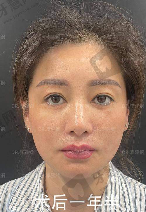 疤痕隐形技术:近乎无痕的理想体验