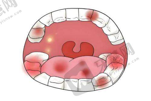 技术优势:为什么吸附性义齿值这个价?