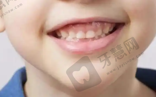 牙齿矫正相关知识科普