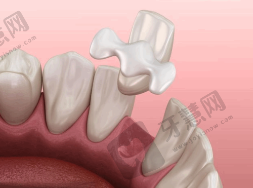 上海牙冠价格表