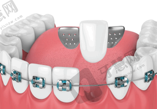 兰州种植牙哪家医院好?不吹不黑,看牙好的三巨头牙科上榜之种植牙的注意事项