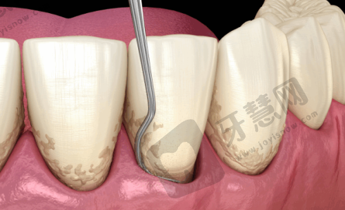 老年人种牙特色服务