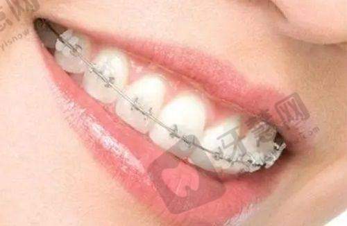 兰州种植牙哪家医院好?不吹不黑,泰兴嘉植/洛阳友好等牙科上榜