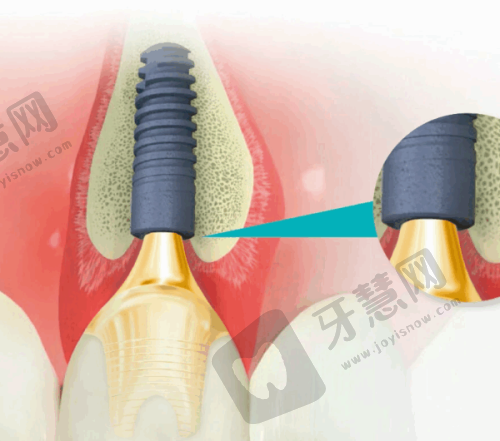 与其他修复项目的比较