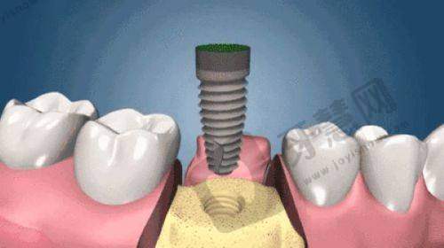 兰州那家医院拔牙便宜之兰州博邦齿科口腔