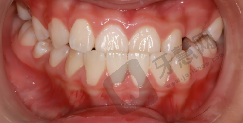 2025年种植牙收费标准