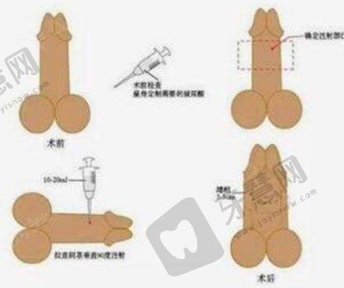 南京哪个医院取奥美定技术好?南京大学医学校附属金陵医院烧伤整形科