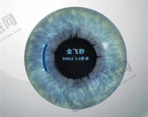 爱尔眼科义眼片价格是多少?定制价格3000-20000元,医院口碑好