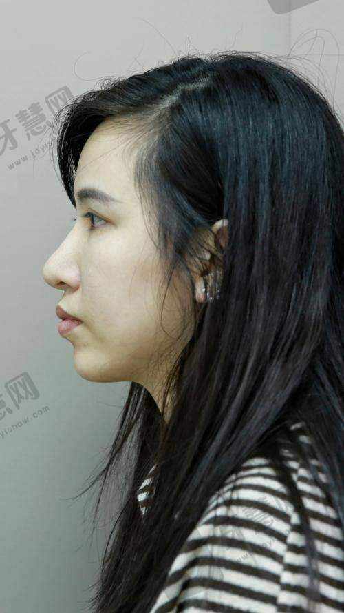 长沙市凸嘴矫正哪家好?前三甲名单揭晓,长沙口腔矫正实力医生推荐