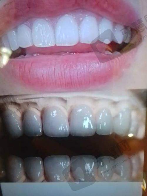 长沙市牙贴面手术医院排名前三权威发布,长沙牙齿贴面哪家医院好且价格便宜看这里!