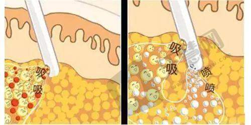 北京加减美穆宝安拉皮患者口碑怎么样