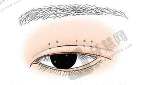 北京加减美穆宝安拉皮手术价格贵吗