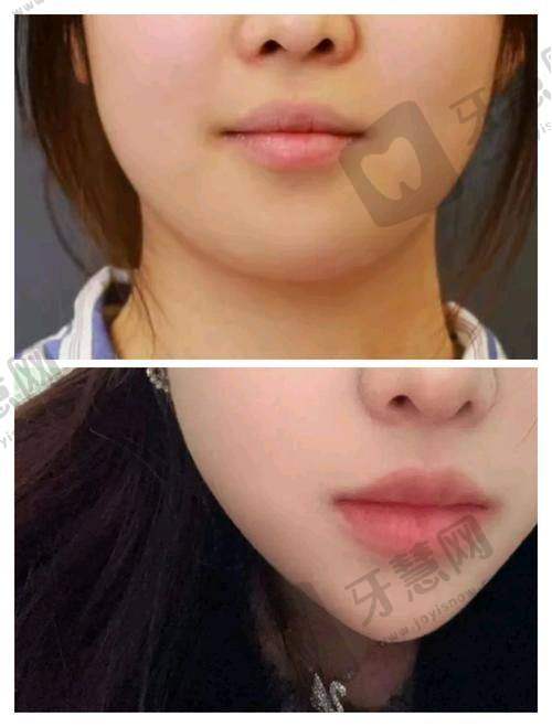 美莱玻尿酸海薇2025多少钱?官方授权医院|指定医生注射+海薇M+1980元起/支!