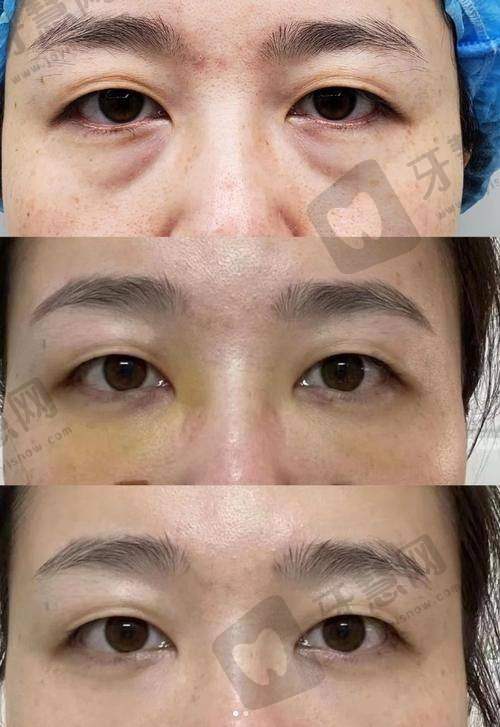 郑州王杨医生眼袋修复卧蚕多少钱?“郑州美眼王杨”不同术式价格及效果都看看