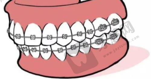 广州暨南雅皓口腔医院2025全新收费揭秘,种牙3800、正畸7500起,医生团队超靠谱