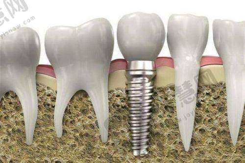 四、2025年广州柏德口腔医院价目表